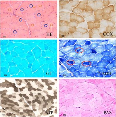 Case report: A novel mutation of the CAPN3 gene in a Chinese family with limb-girdle muscular dystrophy type 2A